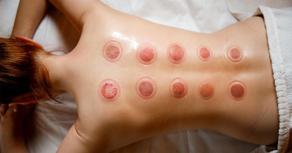 بادکش درمانی و حجامت